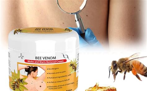 Bee Venom: Best Cure for Skin Tags?