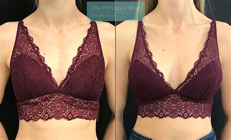 Small Boob Job: Discover Subtle Enhancement Techniques